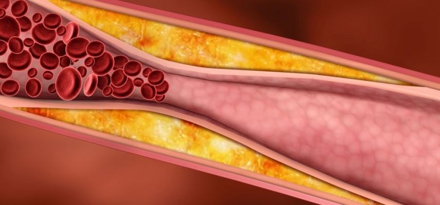 Diabetes y dislipidemia