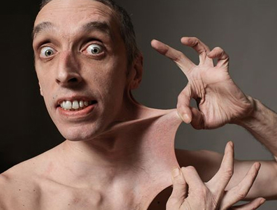 ¿Qué son los Sindromes de Ehlers-Danlos?